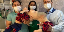 Conjoined twins with fused brains have been successfully separated
