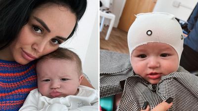 Marnie Simpson reveals her baby boy has plagiocephaly