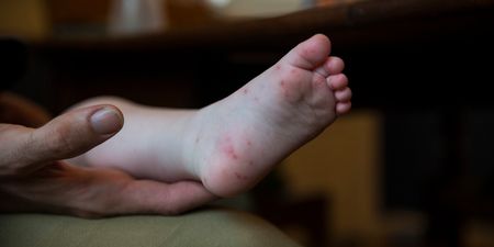 HSE urges parents to keep children with Hand, Foot and Mouth disease out of school