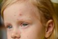 16 people have died from invasive Strep A since October, HSE confirms