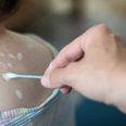 Chickenpox vaccine might be free after public consultation