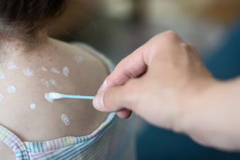 Chickenpox vaccine might be free after public consultation