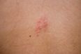HSE issues shingles warning – here are the symptoms to look out for