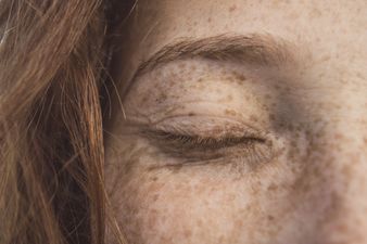 Vhi promises ‘faster and more effective’ dermatology services with latest partnership