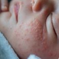 From eczema to nappy rash, baby’s skin is among the top parenting concerns