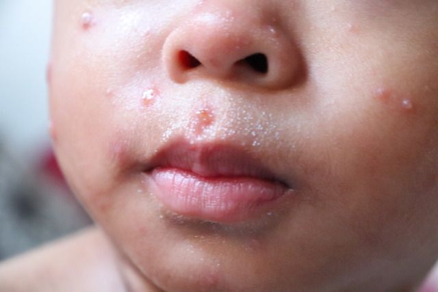 baby acne