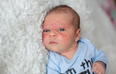 What is baby acne? Signs, symptoms and treatment