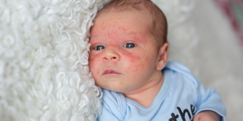 Did you know babies can get acne? The signs, symptoms, and treatments
