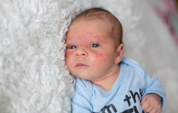 Did you know babies can get acne? The signs, symptoms, and treatments