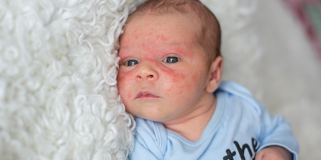 What is baby acne? Signs, symptoms and treatment