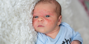 Did you know babies can get acne? The signs, symptoms, and treatments