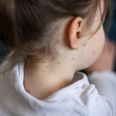Measles: Latest report shows increase of possible cases in Ireland last week
