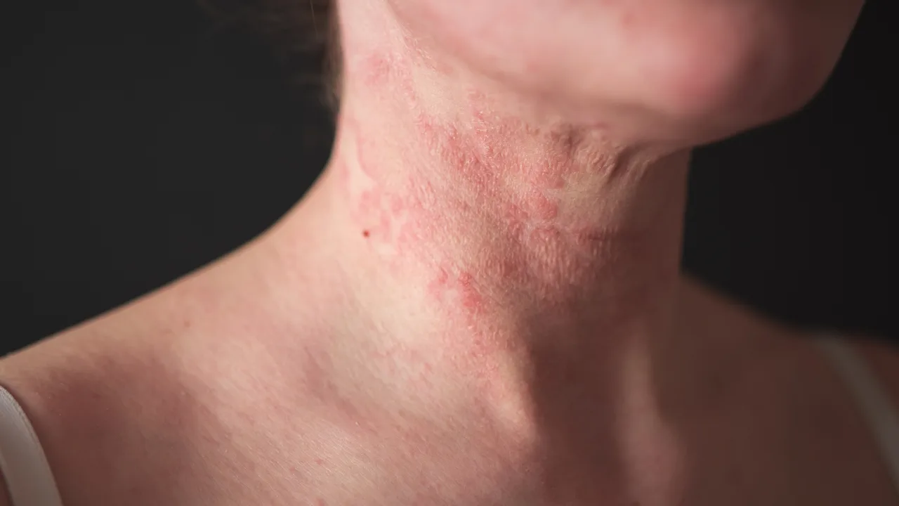 Expert reveals essential tip for preventing and treating eczema