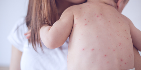 Warning issued after suspected case of measles at Dublin creche
