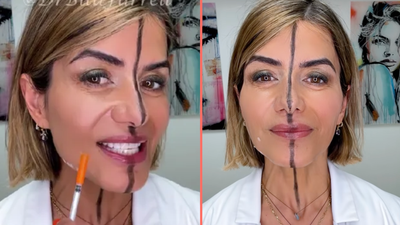 Doctor shares side effects of Botox after injecting only one side of her face